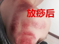 刮痧视频教程,跟随视频教程轻松掌握刮痧技巧
