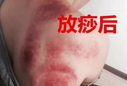 刮痧视频教程,跟随视频教程轻松掌握刮痧技巧