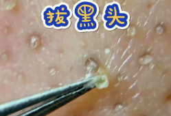 粉刺视频,视频教你轻松应对